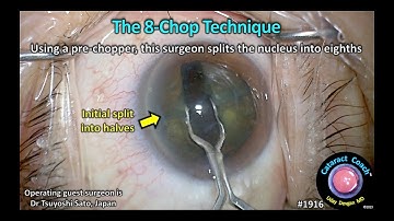 CataractCoach™ 1916: The 8-Chop Technique - Pre-Chopper