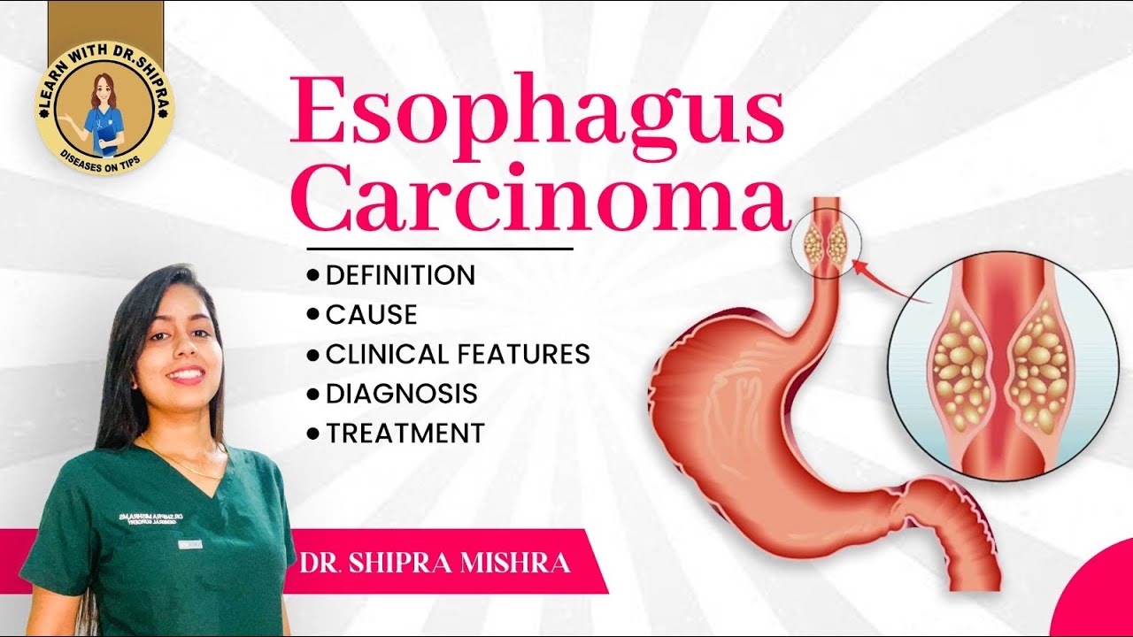 Esophagus Cancer in Hindi (Cause, Symptoms, Diagnosis, Treatment) Dr