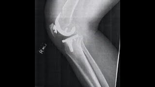 Backpacking w/Total Knee Replacement