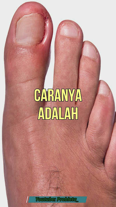 ATASI SEBELUM TERLAMBAT!!! CARA MENGOBATI CANTENGAN DI RUMAH