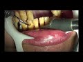上尾の歯医者の歯周病・口臭予防の歯石取り動画 R5年7月28日 | 健康・口腔ケア
