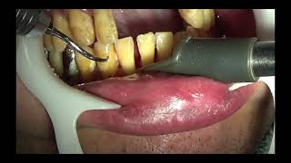 上尾の歯医者の歯周病・口臭予防の歯石取り動画 R5年7月28日 |  健康・口腔ケア