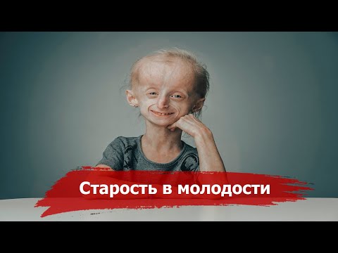 Прогерия – когда Старость приходит в Детстве | Коротко о Прогерии