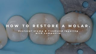 Comment Restaurer Une Molaire - Tampon Occlusal Et Stratification À Main Levée Avec Composite