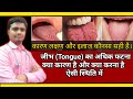 Cracked Fissure On Tongue ज व ह पर गहर दर र बनन क रण लक षण और इल ज Best Homeopathic Treatment Cracked Fissure On Tongue ज व ह पर गहर दर र बनन क रण लक षण और इल ज Best Homeopathic Treatment
