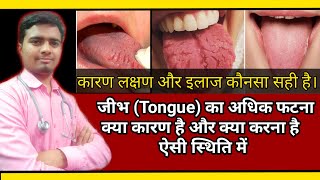 Cracked (Fissure On Tongue)  जिव्हा पर गहरी दरार बनना कारण लक्षण और इलाज Best Homeopathic Treatment screenshot 4
