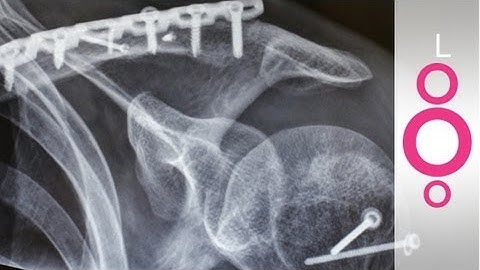 Why is it better to glue bones than to pin them? - do you know?