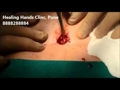 hernia treatment in homeopathy in hindi Laser Pilonidoplasty