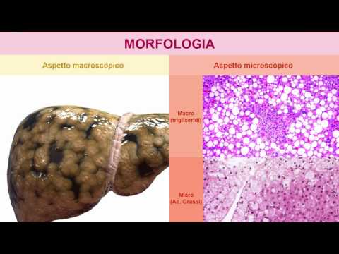 Video: L'amiloidosi Finlandese Da Gelsolina Provoca Un Significativo Carico Di Malattia Ma Non Influenza La Sopravvivenza: Studio FIN-GAR Di Fase II