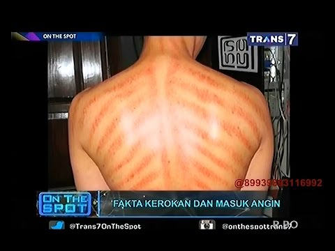 On The Spot - Fakta Kerokan Dan Masuk Angin