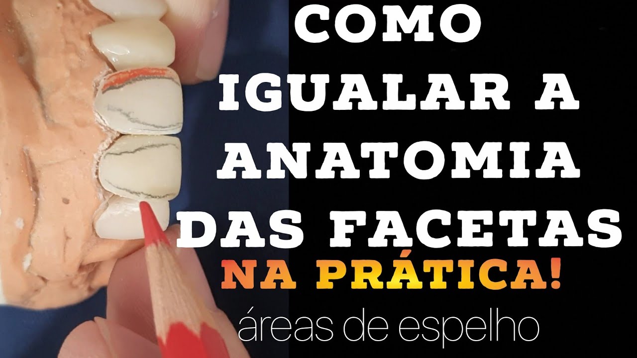 🛑COMO IGUALAR A ANATOMIA E ÁREAS DE ESPELHO em FACETAS Em Resina:ANATOMIA SECUNDÁRIA  na Prática!🤫🤫🤔