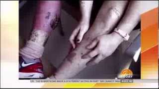 Boston bombing victim and his nurse fiance appear on TODAY Boston bombing victim and his nurse fiance appear on TODAY