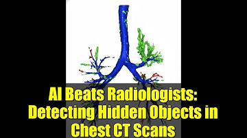 AI Beats Radiologists: Detecting Hidden Objects in Chest CT Scans