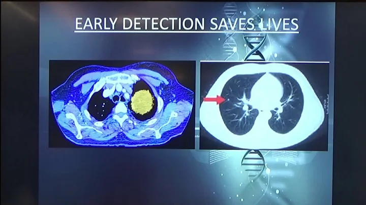 Preventive Medicine and Cancer Care talk by Dr. Ma...