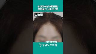 50대 여성 헤어라인 두피문신 전/후｜자연스러운 라인 채움 시술 과정 공개