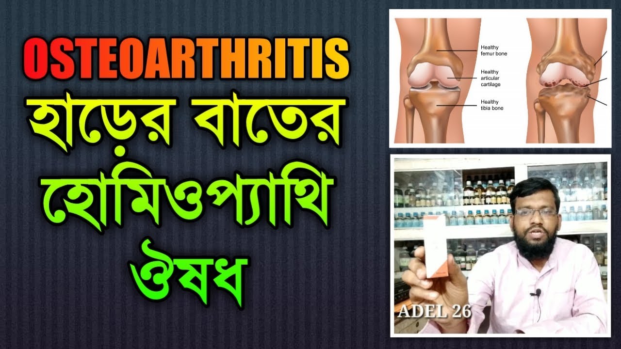 অস্টিও আর্থ্রাইটিস হাড়ের বাতের হোমিওপ্যাথি ঔষধ চিকিৎসা ও উপায় | osteoarthritis treatment in bangla