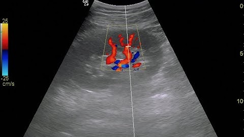 Renal Doppler Ultrasound