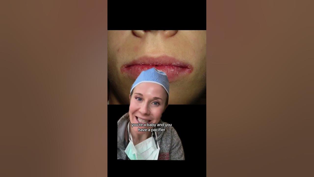 Angular cheilitis (perleche) is often due to bacteria or fungus