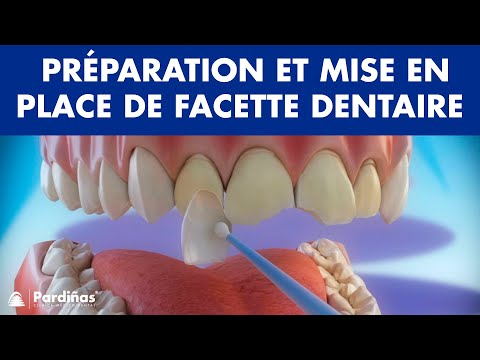 Vidéo: Facettes dentaires amovibles : avantages et inconvénients