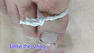 English v1: Ingrown toenail correction device &quot;NailLift&quot; on the surface procedure