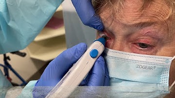 Tonopen AVIA | ⚙️ How to measure intra ocular pressure