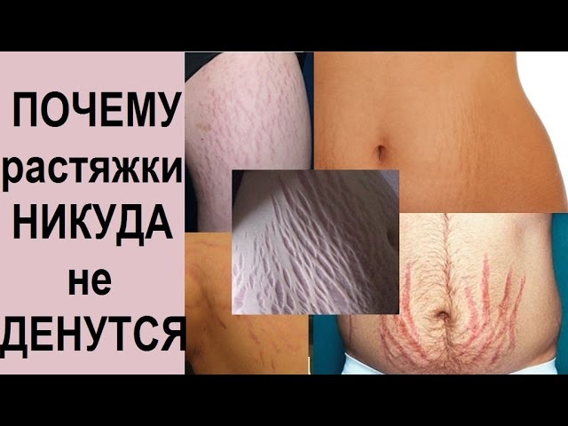 РАСТЯЖКИ: за что мне это и как их убрать??? #смирисьснеизбежным