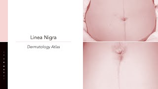 Linea nigra