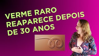 Verme raro reaparece após 30 anos! trichenela