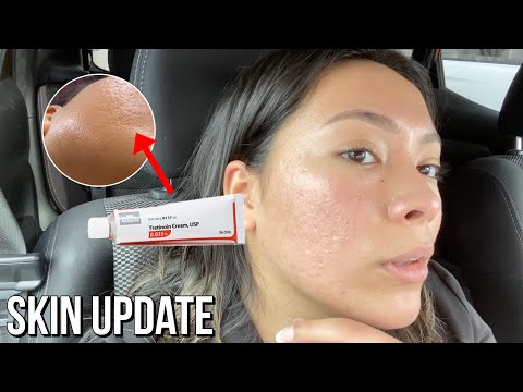 Using Tretinoin...UPDATE