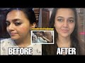 Acne & Oil Control With The #OneBottleChallenge | Does it work??
