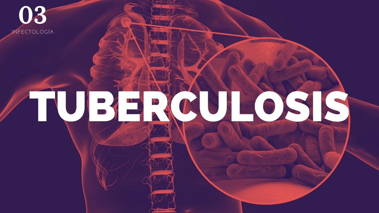 Tuberculosis (A DETALLE) - ENARM