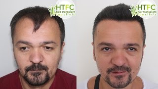 3700 Grafts Fue Hair Transplant Fue Clinic Turkey