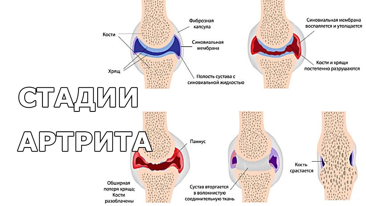 Артрит стандарты