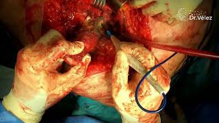 Cirugía de resección de femur proximal y reconstrucción con megaprótesis