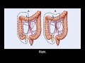 Surgery Treatment Options for Colorectal Cancer | Memorial Sloan Kettering