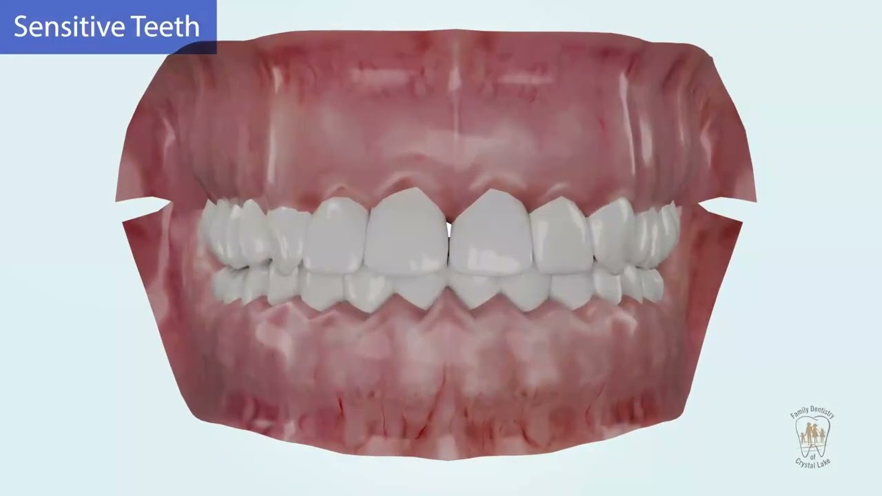 What Causes Tooth Sensitivity? Treatment Options for Lasting Relief