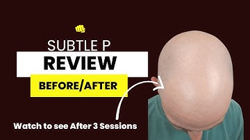 Subtle Pigmentation Case Study | Before & After |