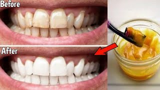 تبييض الاسنان الصفراء طبيعيا في المنزل في 2 دقائق /كيف تبيض أسنانك الصفراء طبيعيا