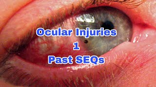 Ocular injuries || Part 1 || SEQs || mbbs || eye | ophthalmology | ocular | 4rth year | jatoi
