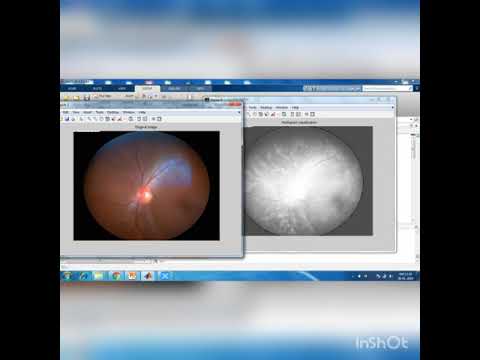 prediction of given image normal or glaucoma-Eye(CII)