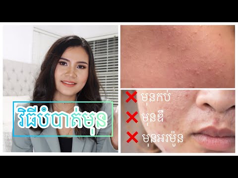 វិធីព្យាបាលមុនមានប្រសិទ្ធភាពនិងមិនប៉ះពាល់ស្បែកទៅថ្ងៃមុខ My acne skin care routine