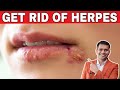 Get Rid Of Herpes | Try This If You Are Suffering from HERPES- Dr. Vivek Joshi