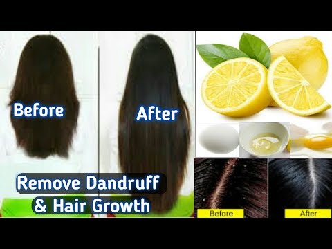 How to get rid of dandruff permanently at home || بالوں کی خشکی کا علاج || In Urdu/Hindi 👸