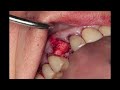 Epi guide membrane placement goldoss graft  suture technique  goldendent