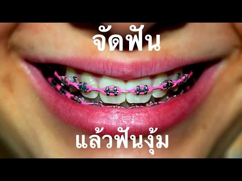 จัดฟันงุ้ม
