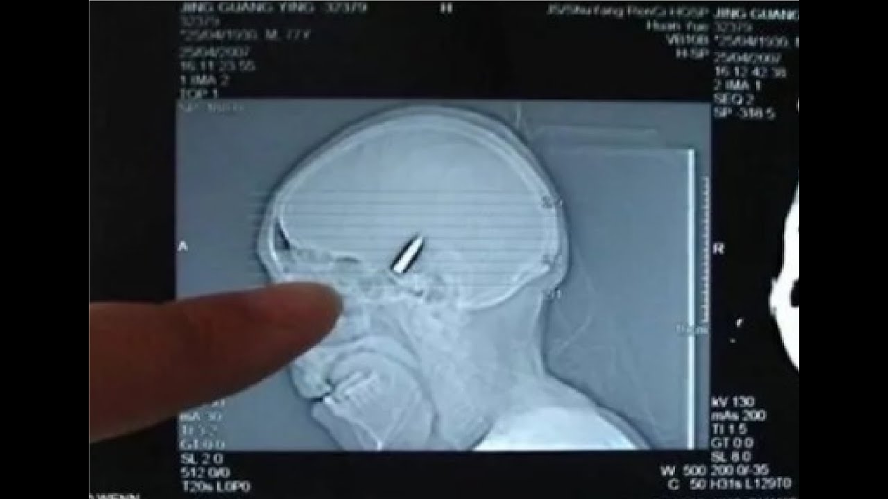 Мозг через рот. Рентгеновский снимок с пулей в голове.