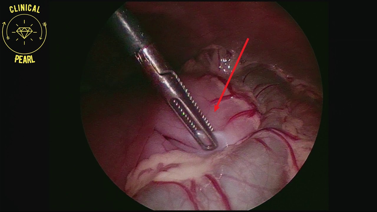 Pediatric Laparoscopic Gastrostomy Youtube