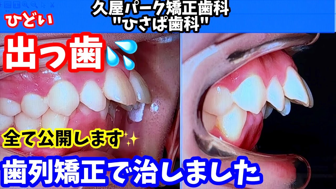 【矯正年間800例】ひどい出っ歯のビフォーアフター！！歯列矯正で治します！！【出っ歯と言ったらヒサパ！】