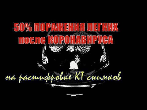 50 ПОРАЖЕНИЯ ЛЕГКИХ на КТ после КОРОНАВИРУСА при полисегментарной двухсторонней пневмонии