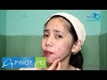 Pinoy md pimple myths mga epektibo at di epektibong paraan para mawala ang pimples